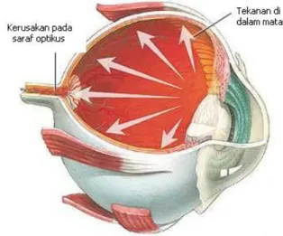 Gambar 2.2. Kerusakan Saraf Optikus pada Glaukoma F. Klasifikasi 