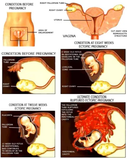 Gambar 3. Komplikasi Kehamilan Ektopik, Ruptur tuba