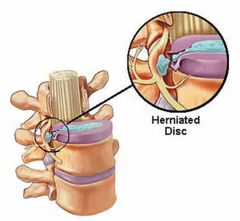 Gambar 1. Herniasi Diskus Sumber: Owens et al., 2010