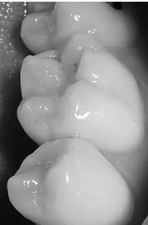 Gambar 2.4 Celah atau fisura gigi dapat menjadi lokasi karies b) Karies permukaan halus