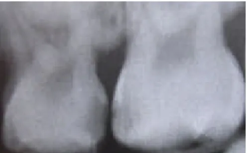 Gambar 2.5 Titik hitam pada batas gigi menunjukkan sebuah karies proksima
