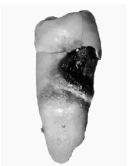 Gambar 2.2 Kerusakan gigi berupa lubang yang disebabkan karies
