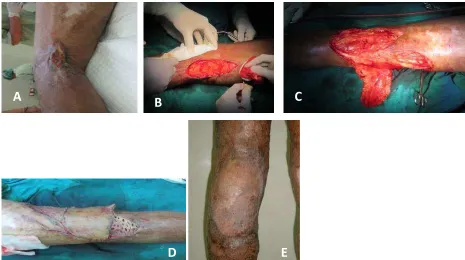Fig. (A) 54-year-old male MU patient burned. (B) Wide excision margin. (C) Regional flap design
