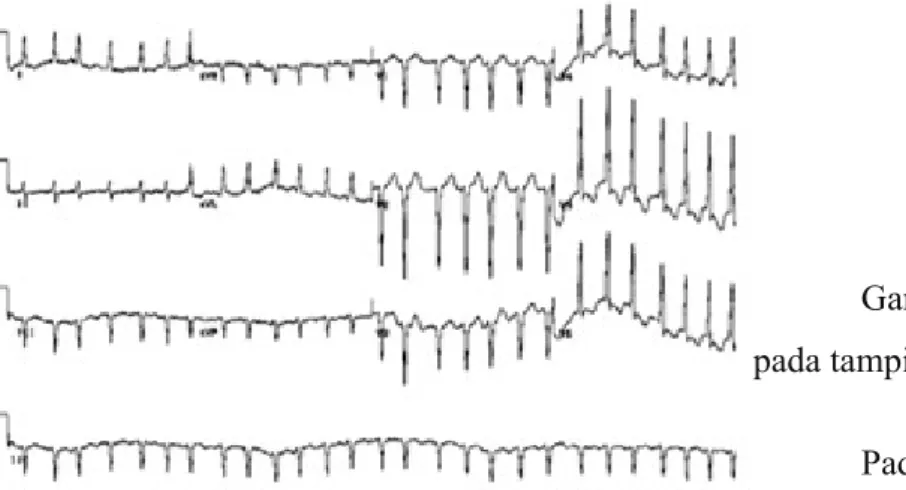 Gambar 2. Grafik atrial fibrilasi pada tampilan EKG 3