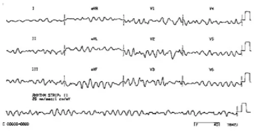 Gambar 1. Grafik fibrilasi ventrikel pada tampilan EKG 2