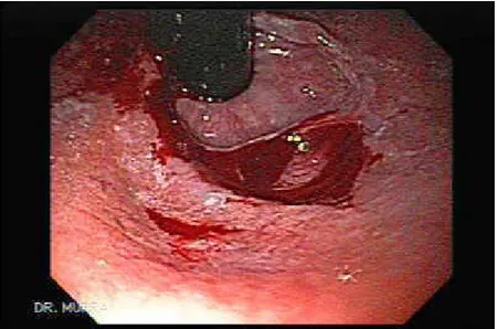 Gambar 2.1. Gambaran endoscopy Mallory-Weiss syndrome (Sumber :  Caesar, 2010)