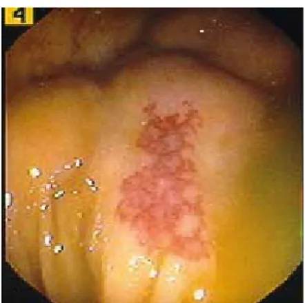 Gambar 2.2. Gambaran endoscopy angiodisplasia (Sumber : Thomson,  2011)