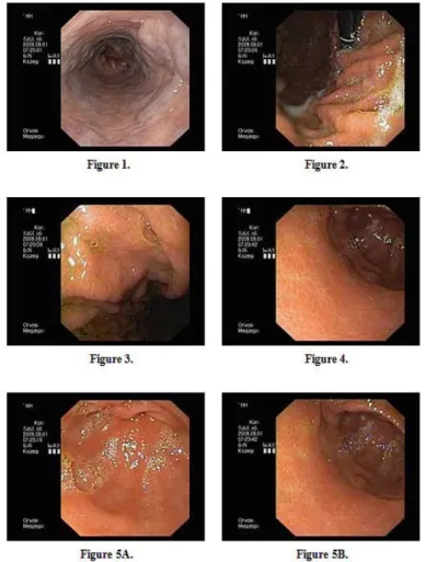 Gambar 2.5. Gambaran endoscopy portal hypertensive gastropathy (Sumber  : Hritz, 2012)