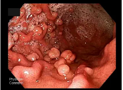 Gambar 2.5. Gambaran endoscopy polip gastric (Sumber : Goddard, 2010) f. Aortoenteric fistula