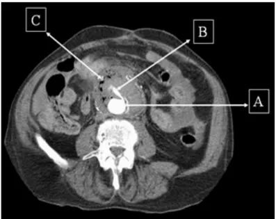 Gambar 2.6. Gambaran CT Scan portal aortoenteric fistula (Sumber :  MacDougall, 2010)