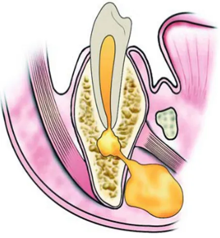 Gambar 2.9 : a. Ilustrasi gambar penyebaran dari abses ke daerah  submandibular di bawah muskulus mylohyoid           b