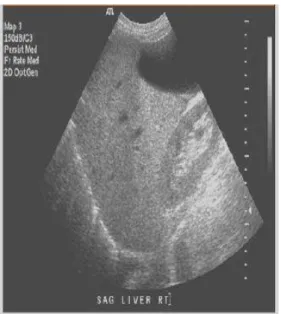 Gambar 1. Pemeriksaan USG abdomen  pada NAFLD. (23) 