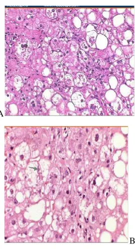 Gambar 2. Steatosis. (23) 