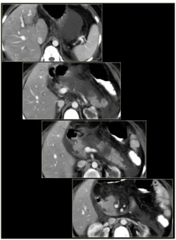 Gambar 9. Gambar diatas menunjukkan pasien dengan ‘central gland necrosis’. Terdapat koleksi                    cairan pada bursa omentalis, disekitar gaster