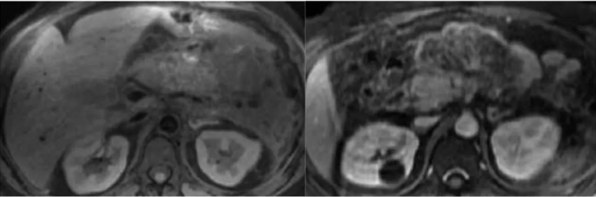 Gambar 10. A. Gambaran MRI T1WI fat-supressed potongan axial , menunjukkan edema dari  kelenjar pankreas dan adanya inflamasi peripankreas, terlihat juga perdarahan kecil di dalam  pankreas
