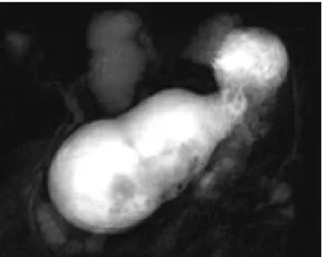 Gambar 9. Gambran MRCP pada pasien severe acute pancreatitis menunjukkan  adanya nekrosis pada pancreatic bed 