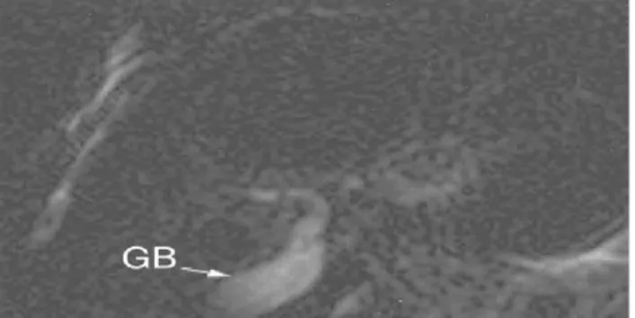 Gambar 6. Pada Atresia Bilier tipe 1, pada MRC (A) tampak ductuli intrahepatic yang hipoplastic (white arrows), yang dapat terlihat pada cholangiography.