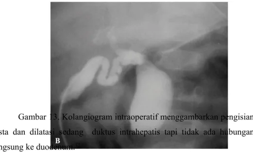 Gambar 13. Kolangiogram intraoperatif menggambarkan pengisian kista   dan   dilatasi   sedang     duktus   intrahepatis   tapi   tidak   ada   hubungan langsung ke duodenum