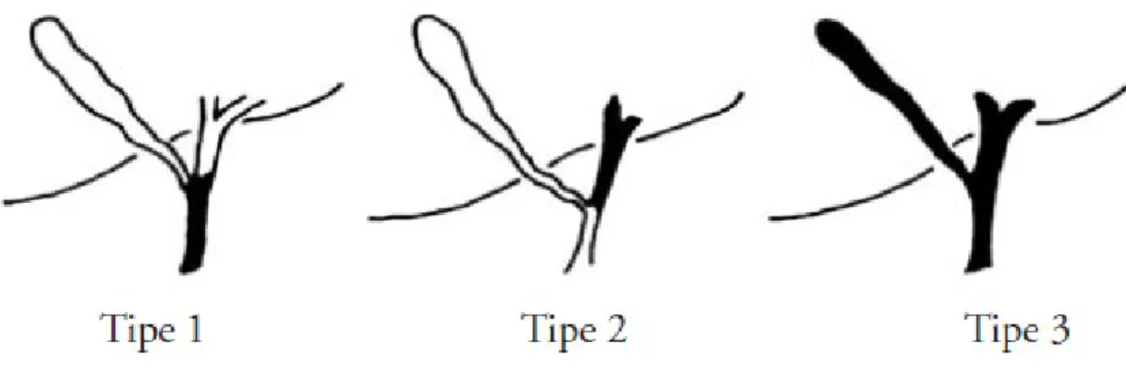 Gambar 1. Tipe atresia bilier. Tipe I obliterasi segmental duktus biliaris komunis; 