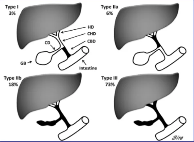 Gambar 2. Skema ilustrasi klasifikasi atresia bilier. Type I, atresia of the common bile ducts with patent gallbladder (GB) and hepatic ducts (i.e