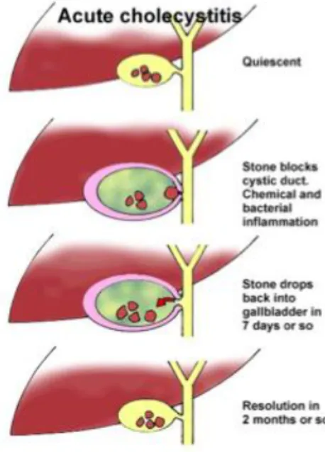 Gambar 3. Patofisiologi kolesistitis akut. 