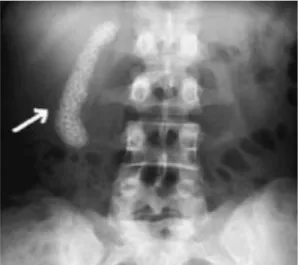 Foto  polos  abdomen  biasanya  tidak  memberikan  gambaran  yang  khas  karena hanya sekitar 10-15% batu kandung empedu yang bersifat radioopak