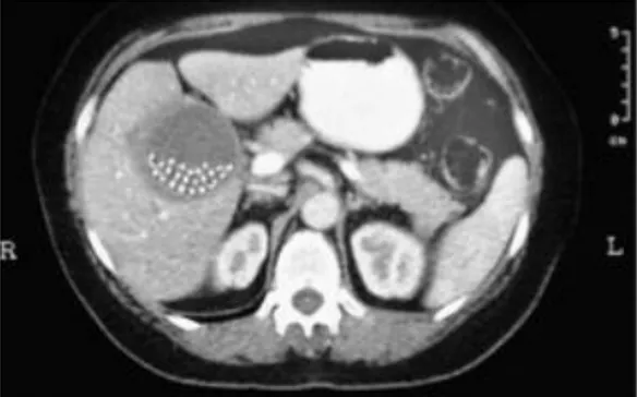 Gambar 6. CT Scan abdomen pada pasien kolesistitis akut menunjukkan adanya batu empedu dan  penebalan dinding kandung empedu