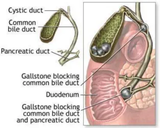 Gambar 3. Batu di dalam kandung empedu dan saluran biliaris. 