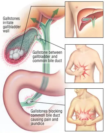 Gambar 2.4 Manifestasi kolelitiasis