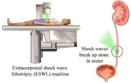 Gambar 2.13 extracorporeal shock wave lithotripsy