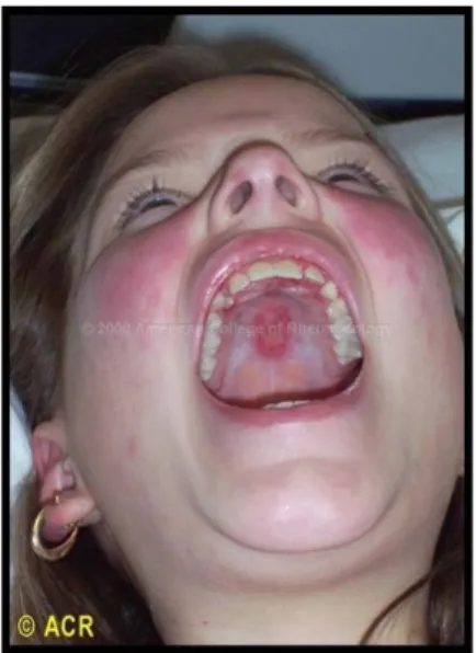 Gambar 2. Ulser oral pada pasien SLE    31 