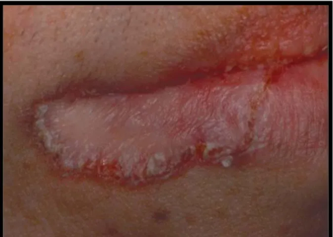 Gambar 6. Lesi bibir bersisik dan merah pada         pasien SLE. 25