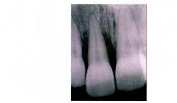 Gambar 1.  Radiografi kehilangan tulang angular akibat penyakit periodontal (Philstrom BL, Michaloicz BS, Johnson NW