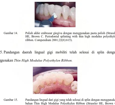 Gambar 14. Polish akhir embrasur gingiva dengan menggunakan pasta polish (Strassler HE, Brown C