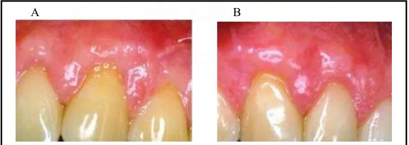 Gambar 3. Resesi gingiva prabedah (Santos A, Goumenos G, Pascual A.   J Periodontol 2005 ;76:1983) 