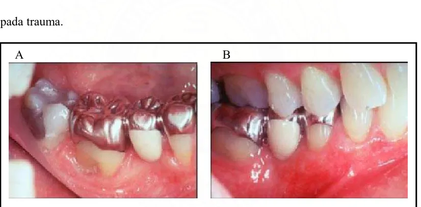 Gambar 10. Kasus 2. A) Gambaran resesi gingiva prabedah B) Gambaran pada tahun pertama pascabedah ( Henderson RD