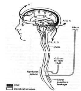 Gambar 1. Patofi sologi Postdura Puncture  Headache 2