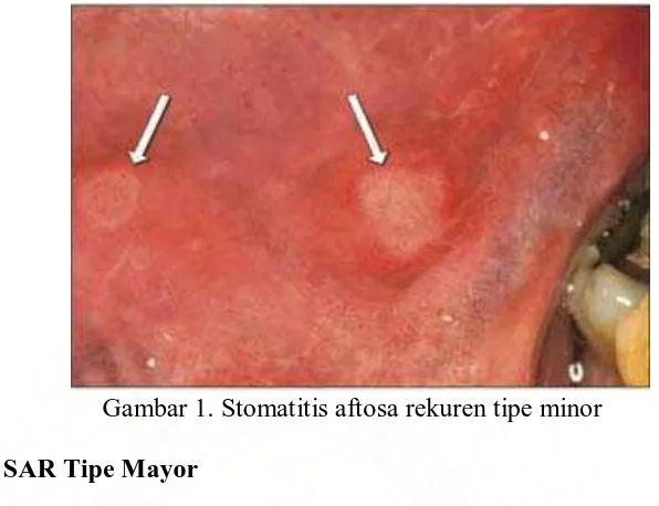 Gambar 1. Stomatitis aftosa rekuren tipe minor 