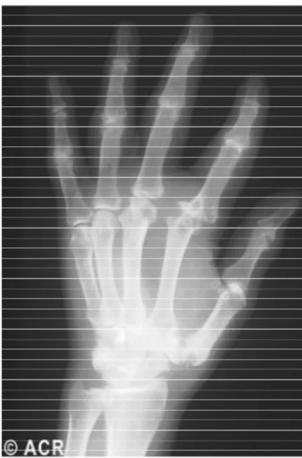 Gambar 3.  Tangan penderita gout kronis, erosi pada  persendian metacarpophalangeal kedua  (Sunkureddi et al., 2006) 
