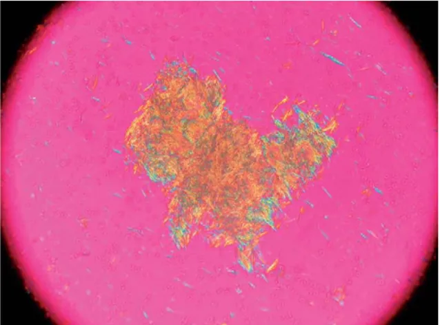 Gambar 4.  Kristal monosodium urat pada cairan tofi, dengan mikroskop  terpolasisasi (Richette dan Bardin, 2010) 