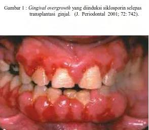 Gambar 1 :                         Gingival overgrowth yang diinduksi siklosporin selepas                     transplantasi  ginjal