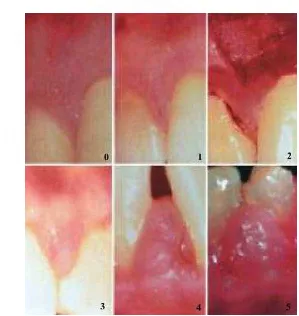 Gambar 3 : Skor gingival overgrowth pada pasien transplantasi                    ginjal  yang  diinduksi  siklosporin