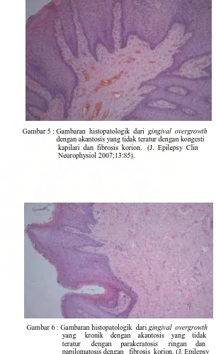 Gambar 6 : Gambaran histopatologik  dari gingival  overgrowth                    papilomatosis dengan   fibrosis  korion
