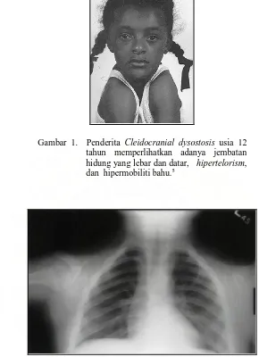 Gambar 1.  Penderita Cleidocranial dysostosis usia 12 tahun memperlihatkan adanya jembatan 