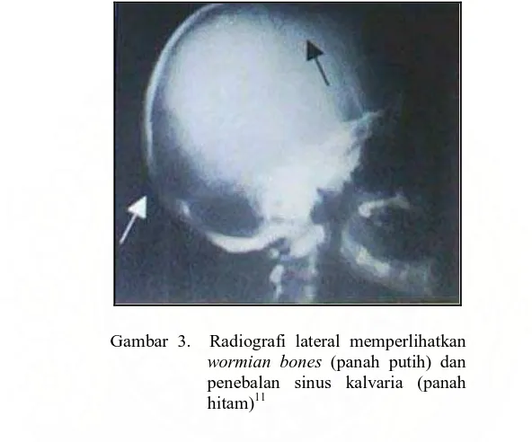 Gambar 3.  Radiografi lateral memperlihatkan wormian bones (panah putih) dan 