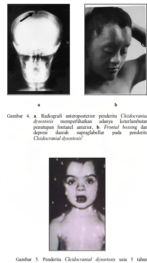 Gambar 4. a. Radiografi anteroposterior penderita Cleidocranial dysostosis memperlihatkan adanya keterlambatan 