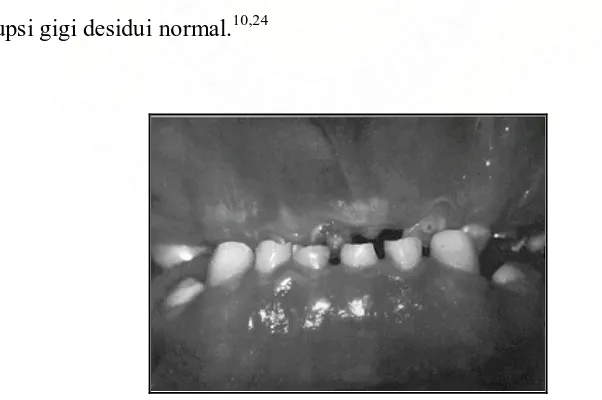 Gambar  8.  Pandangan fasial kondisi gigi geligi penderita Cleidocranial dysostosis usia 12 tahun memperlihatkan persistensi gigi desidui5  