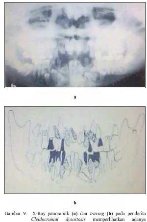 Gambar 9.  X-Ray panoramik (a) dan tracing (b) pada penderita Cleidocranial dysostosis memperlihatkan adanya 
