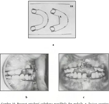 Gambar 10. Pesawat ortodonti sederhana mandibula dan maksila. a. Incisor erupting archwire (x) dan Incisor aligning archwire (xx), b dan c