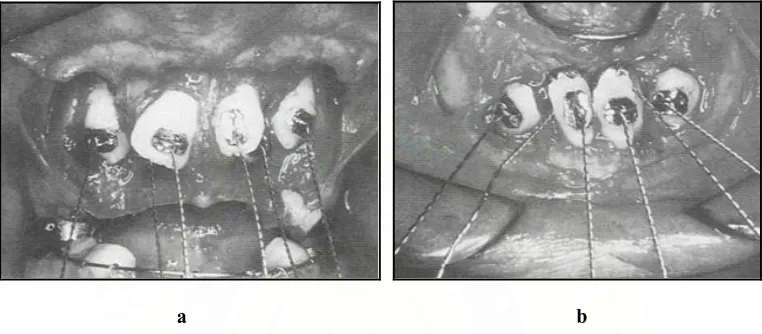 Gambar 13.  Pigtail ligature wire diikat pada eyelets yang melekat pada permukaan gigi yang di-expose